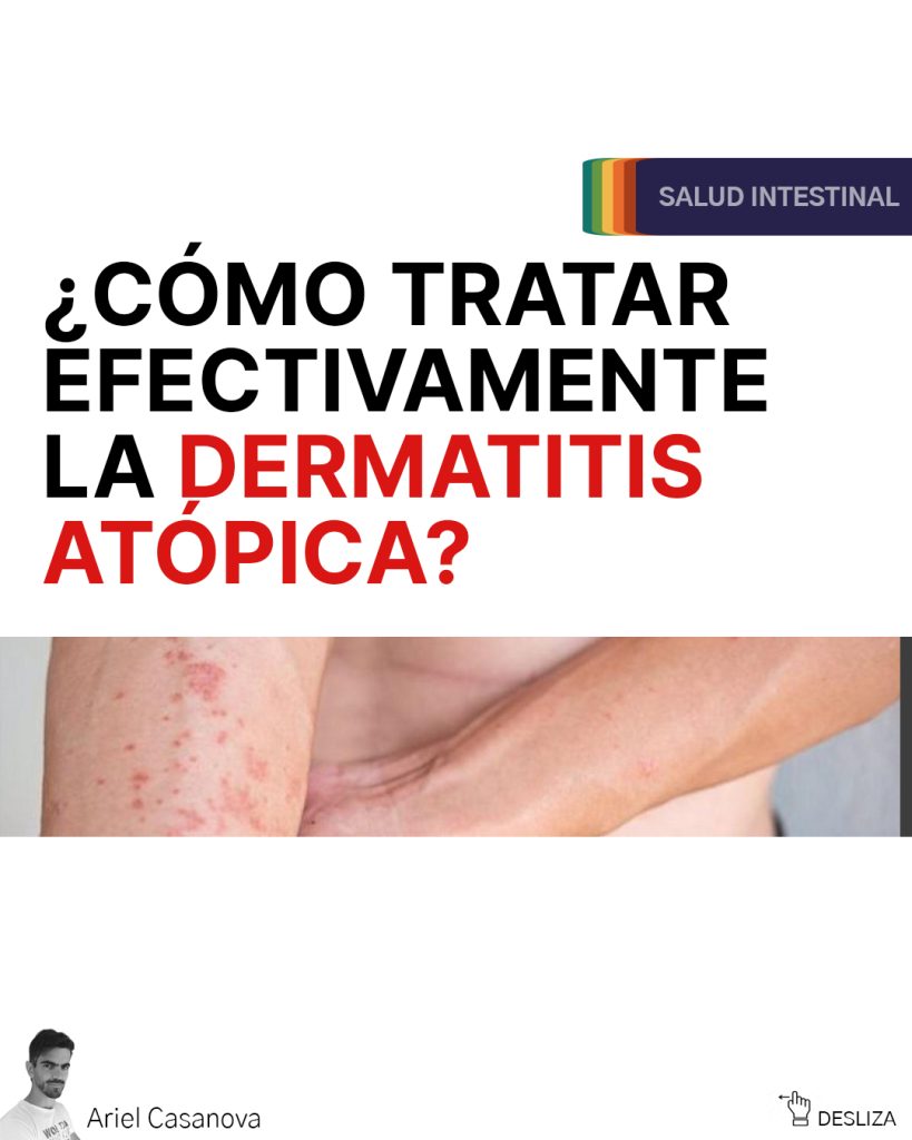tratamiento natural dermatitis atopica